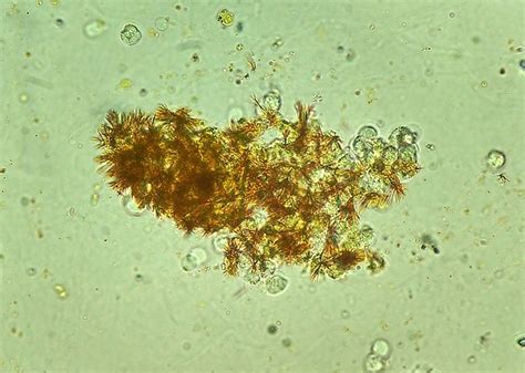 Bilirubin in Urine